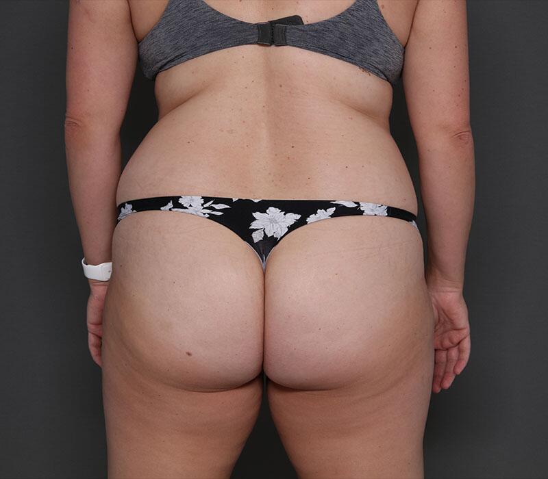 Tummy Tuck Before & After Image