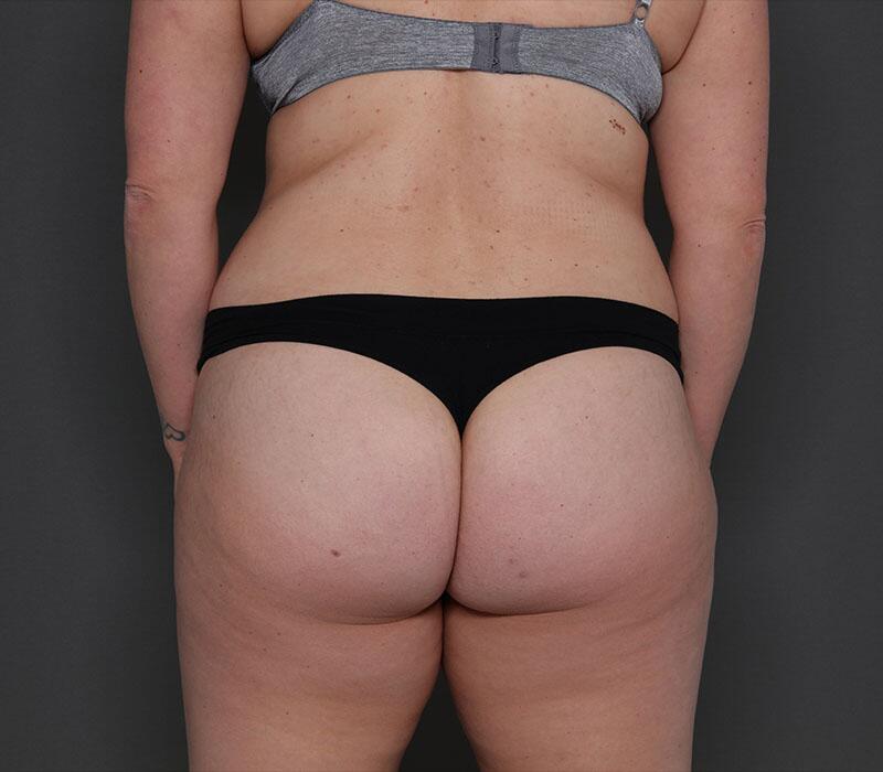 Tummy Tuck Before & After Image