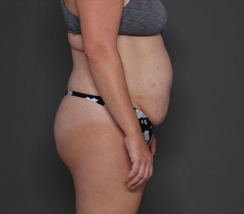 Tummy Tuck Before & After Image