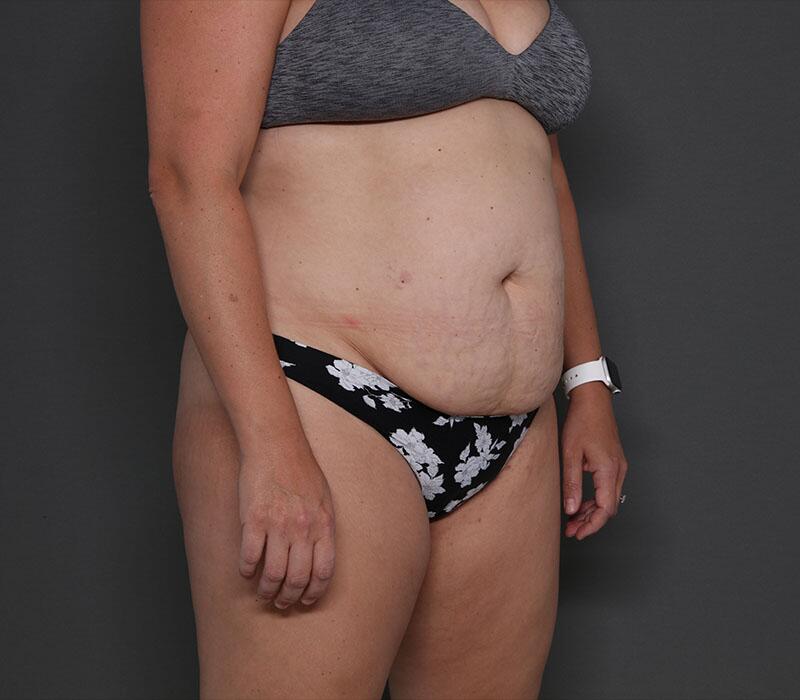 Tummy Tuck Before & After Image