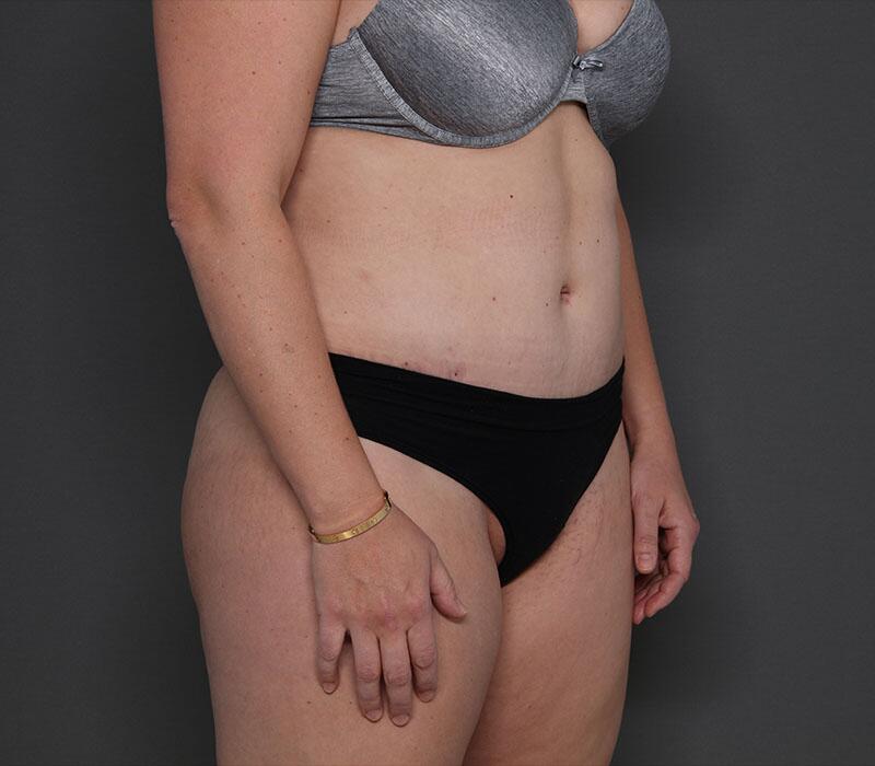 Tummy Tuck Before & After Image