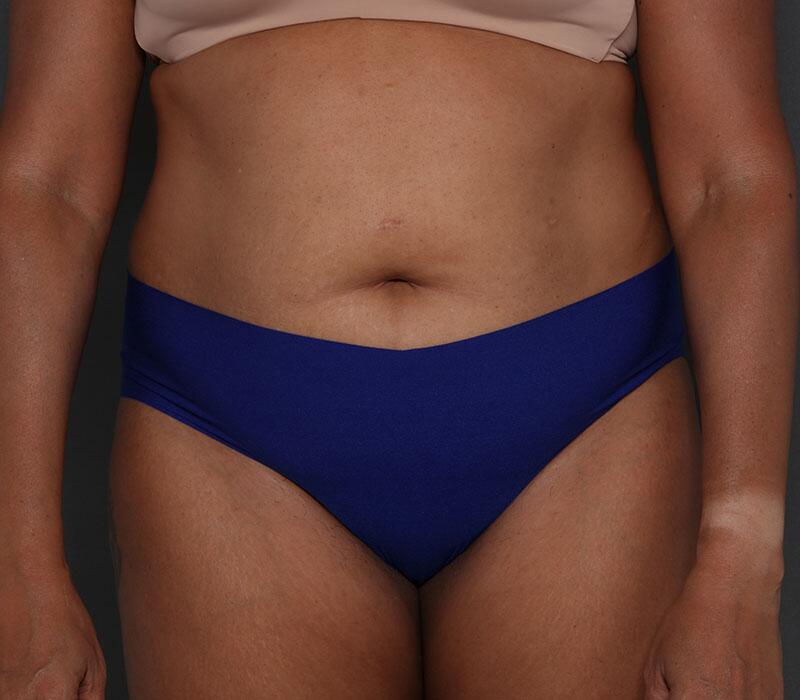 Tummy Tuck Before & After Image