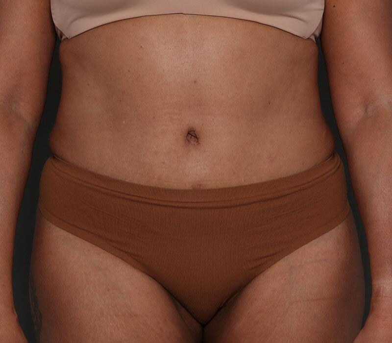 Tummy Tuck Before & After Image