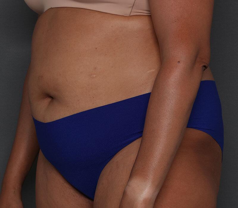 Tummy Tuck Before & After Image