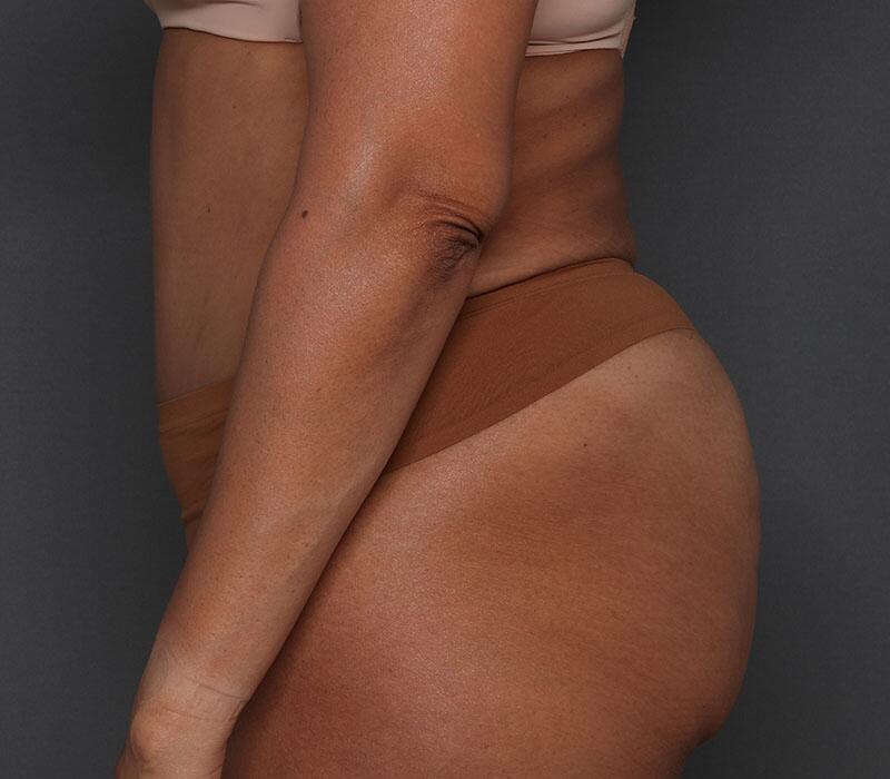 Tummy Tuck Before & After Image