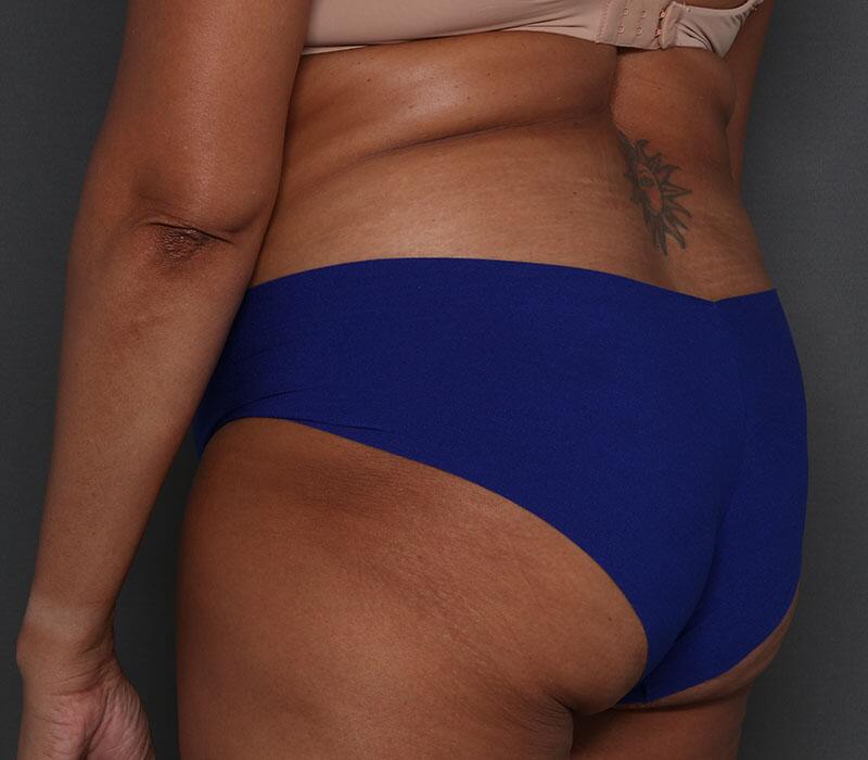 Tummy Tuck Before & After Image