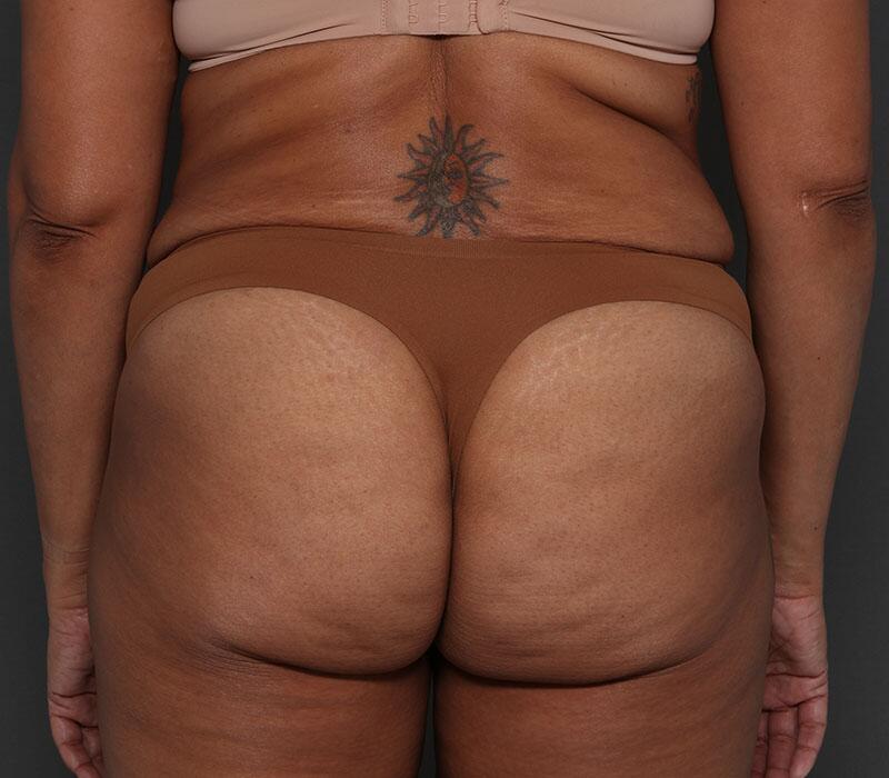 Tummy Tuck Before & After Image