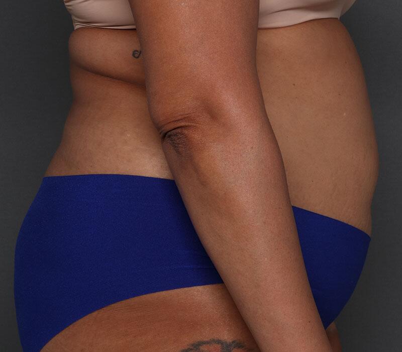 Tummy Tuck Before & After Image