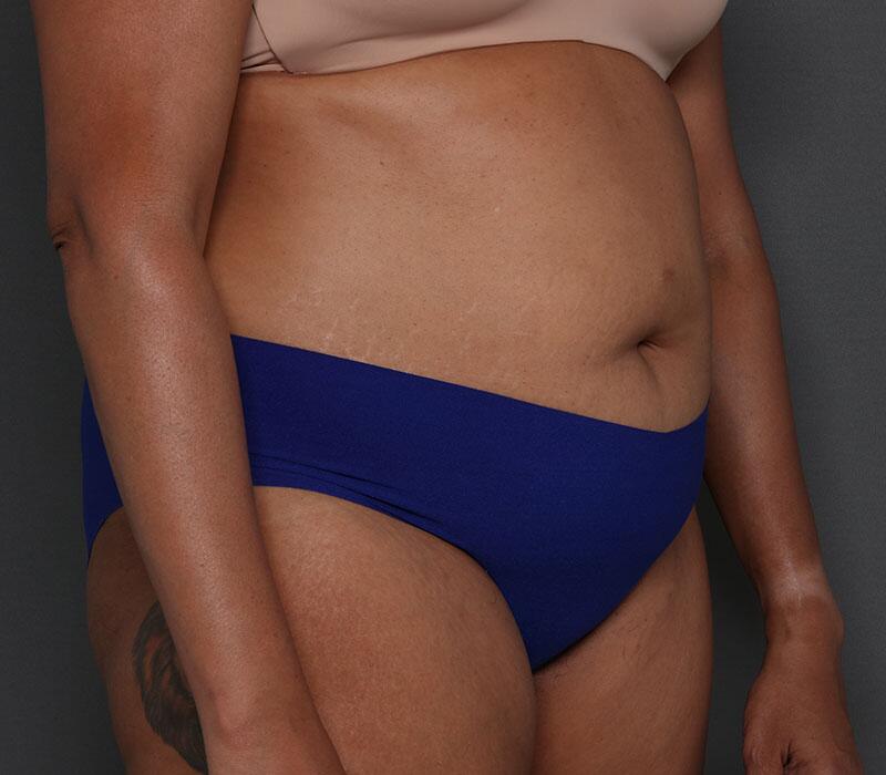 Tummy Tuck Before & After Image