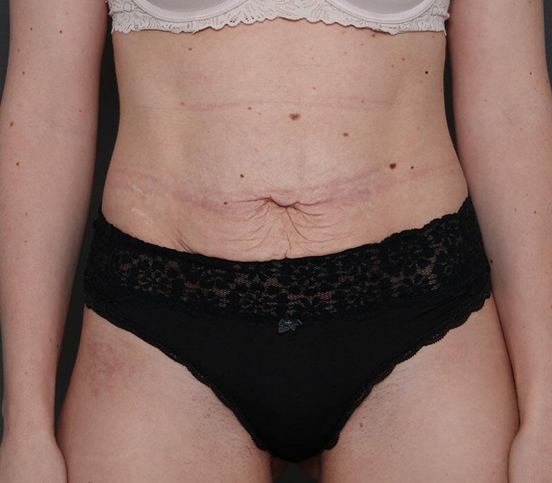 Tummy Tuck Before & After Image