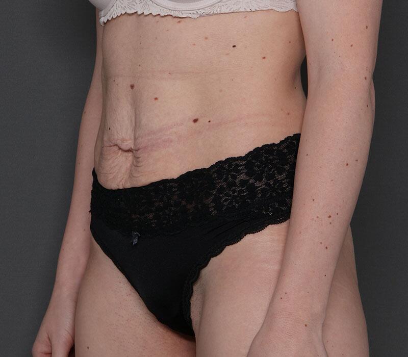 Tummy Tuck Before & After Image