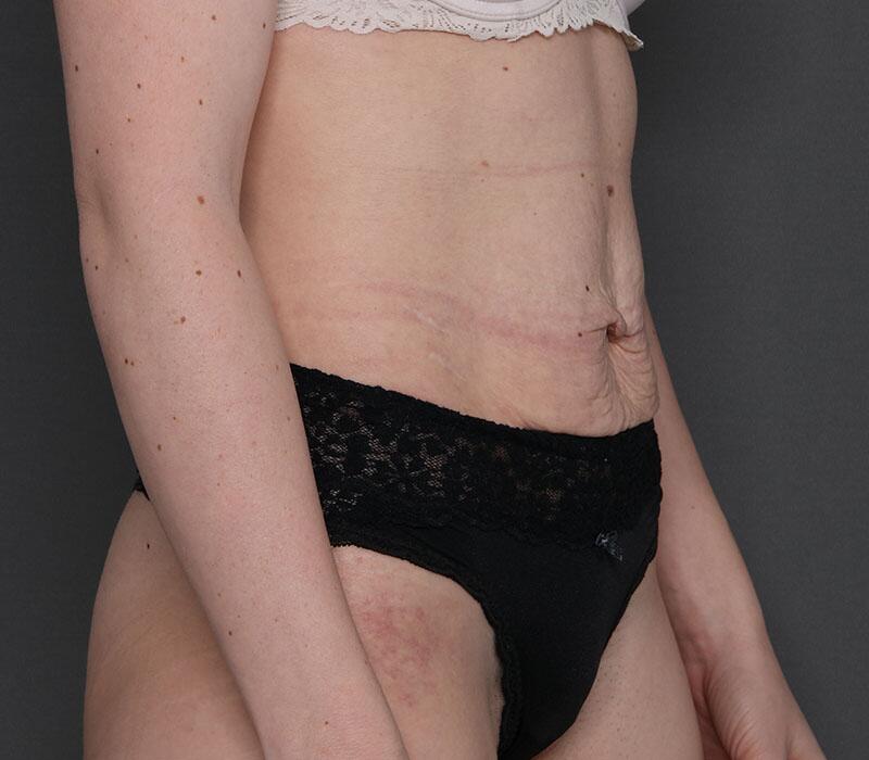 Tummy Tuck Before & After Image