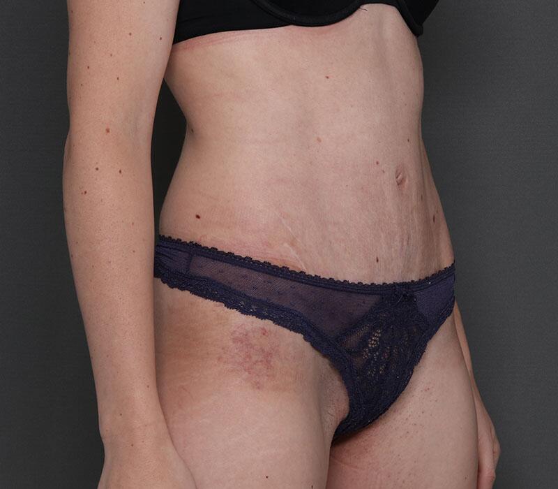 Tummy Tuck Before & After Image