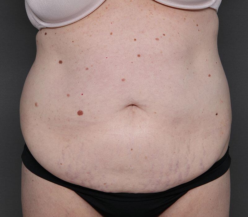 Tummy Tuck Before & After Image