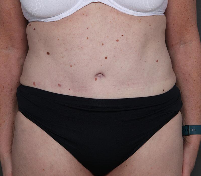 Tummy Tuck Before & After Image