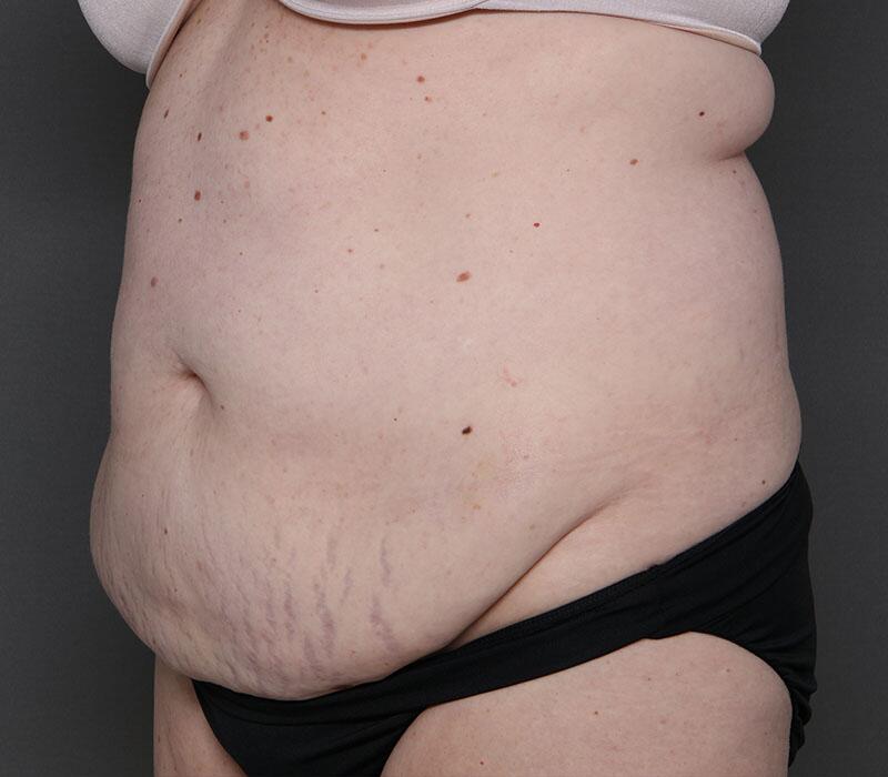 Tummy Tuck Before & After Image