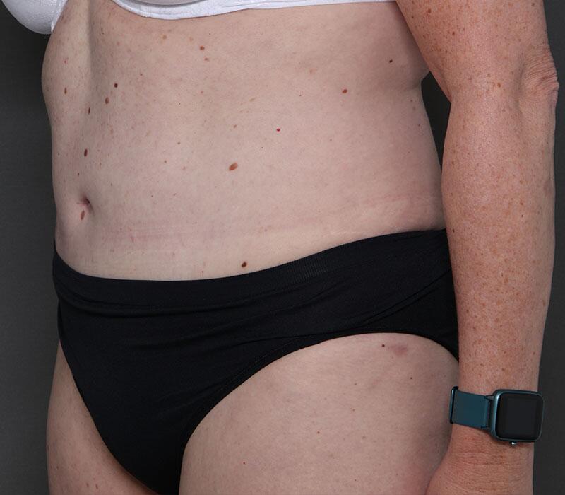 Tummy Tuck Before & After Image