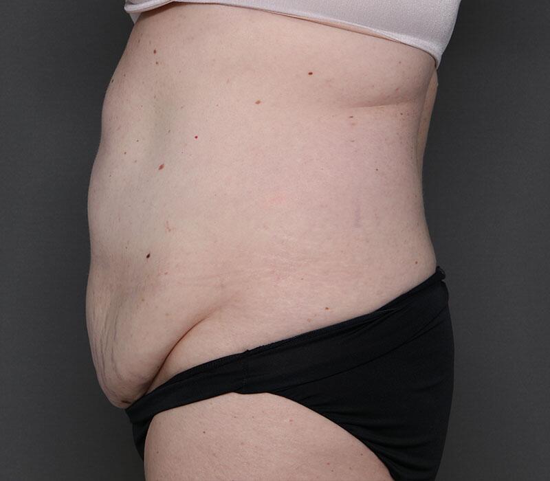 Tummy Tuck Before & After Image