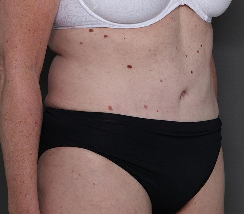 Tummy Tuck Before & After Image