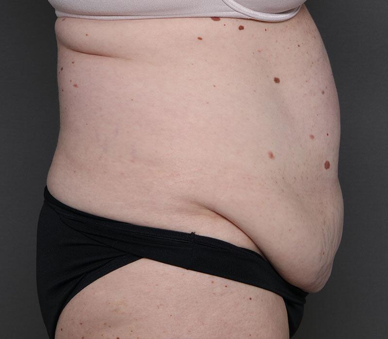 Tummy Tuck Before & After Image