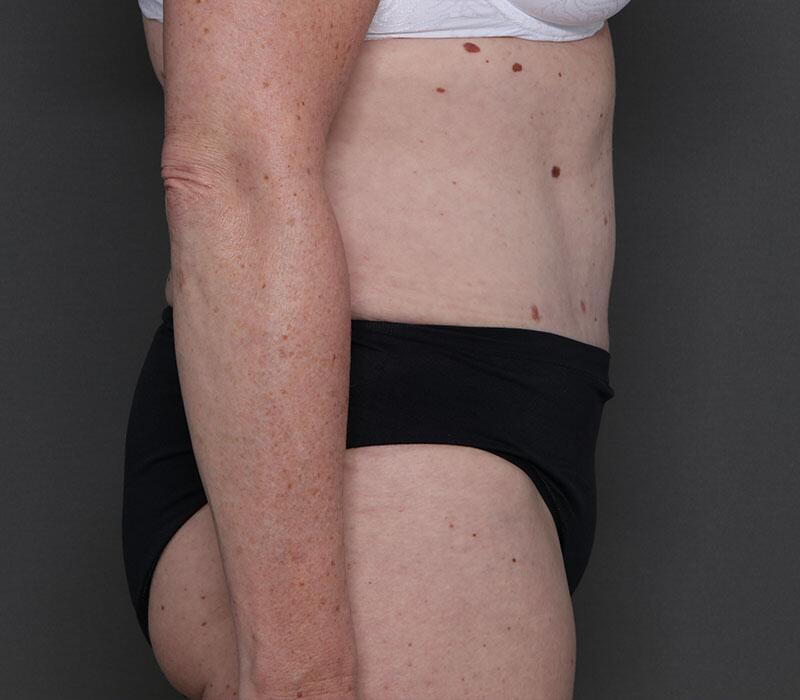 Tummy Tuck Before & After Image