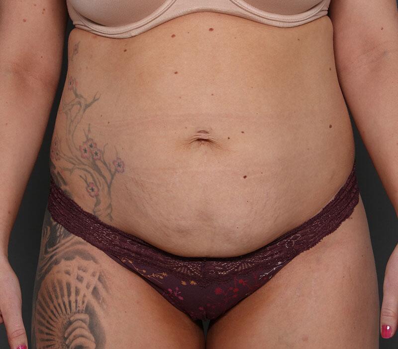 Tummy Tuck Before & After Image