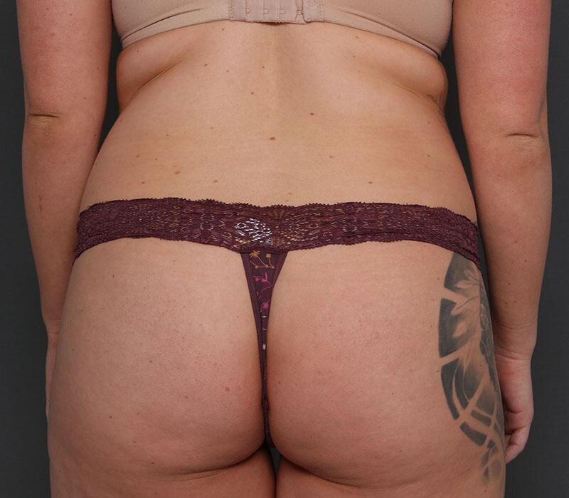 Tummy Tuck Before & After Image