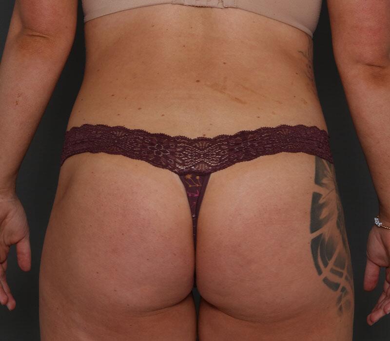 Tummy Tuck Before & After Image