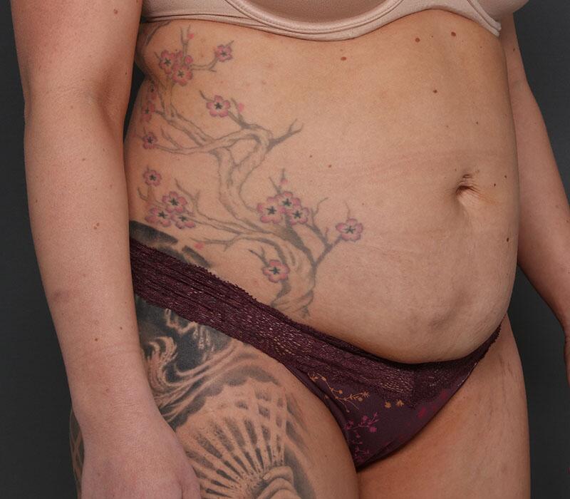 Tummy Tuck Before & After Image