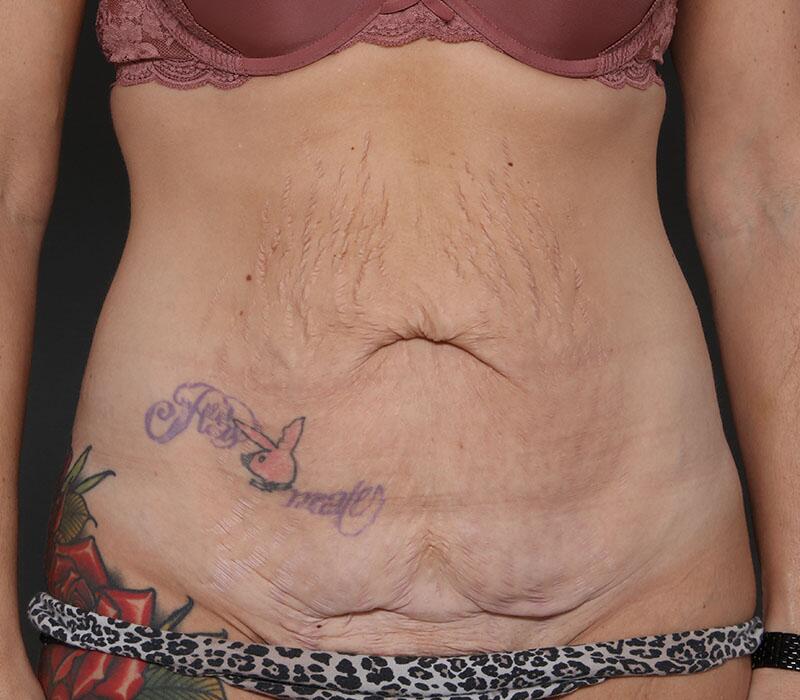 Tummy Tuck Before & After Image