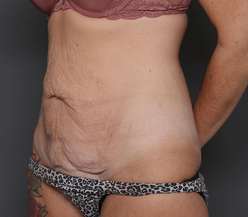 Tummy Tuck Before & After Image