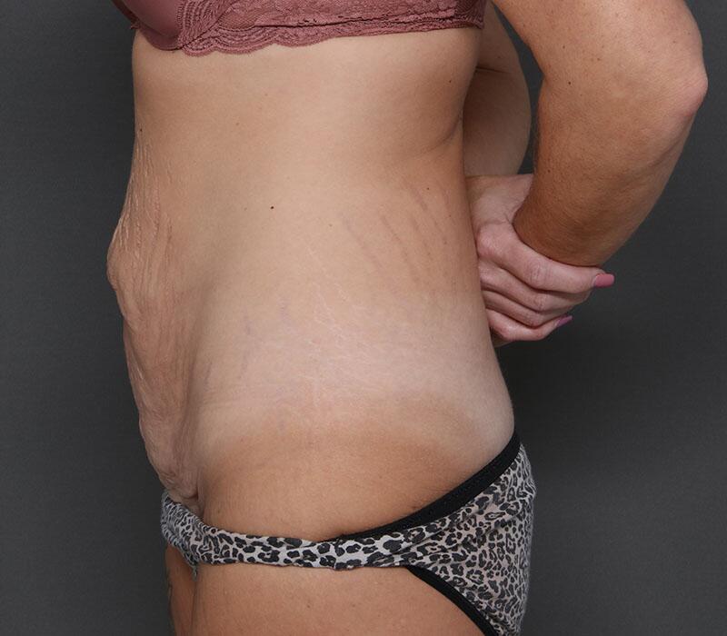 Tummy Tuck Before & After Image