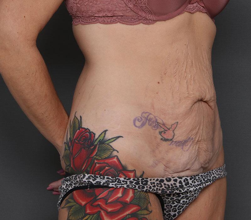 Tummy Tuck Before & After Image