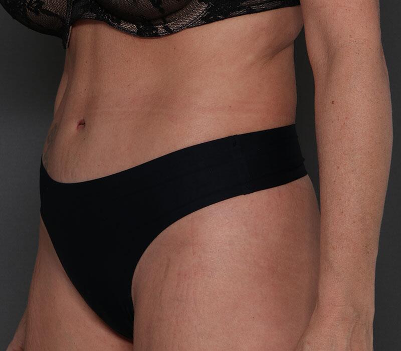 Tummy Tuck Before & After Image