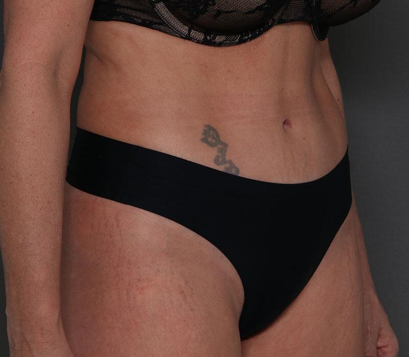 Tummy Tuck Before & After Image