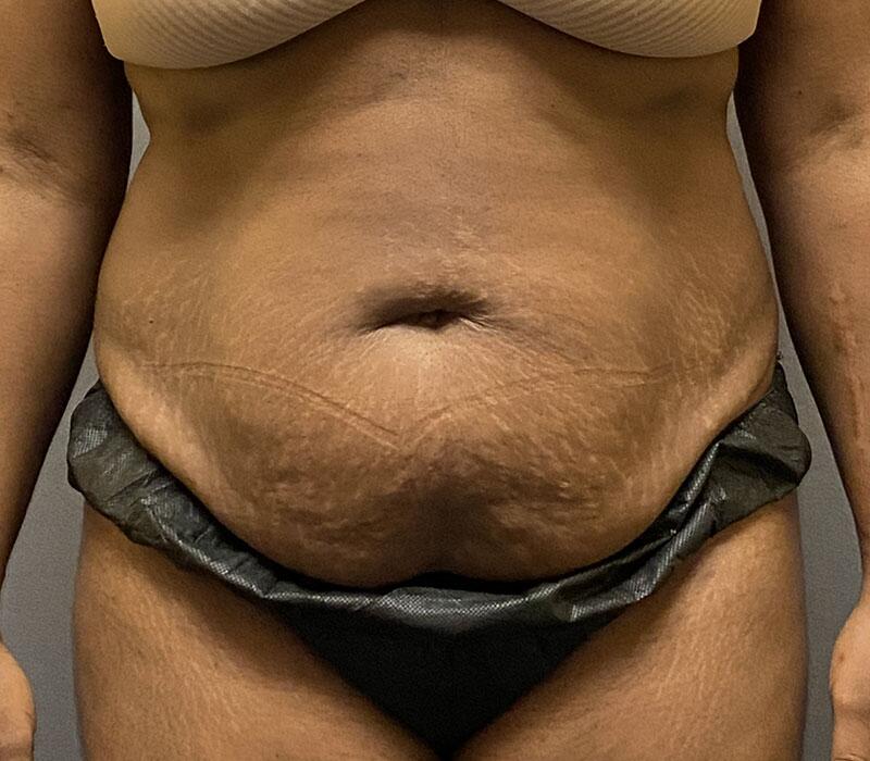 Tummy Tuck Before & After Image