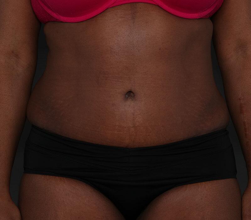 Tummy Tuck Before & After Image