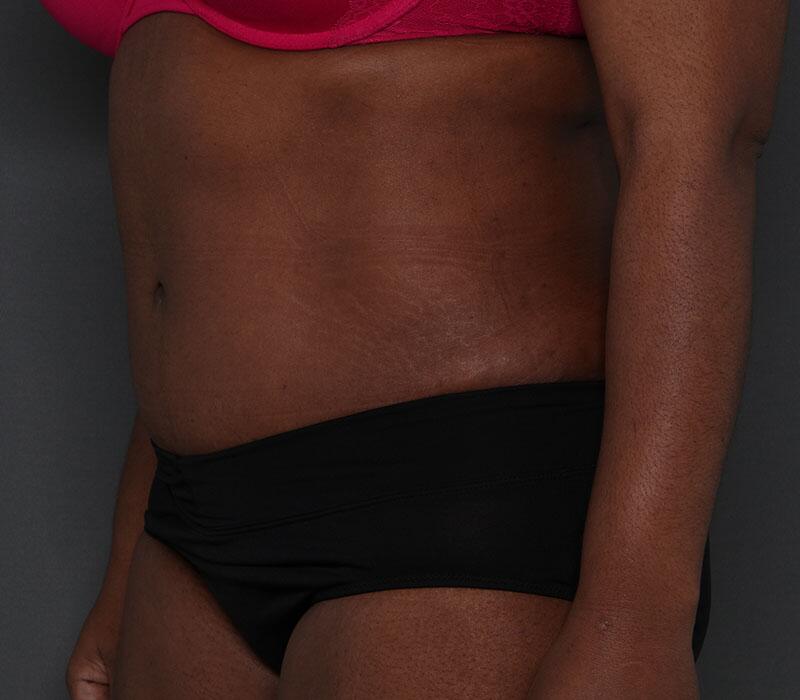 Tummy Tuck Before & After Image