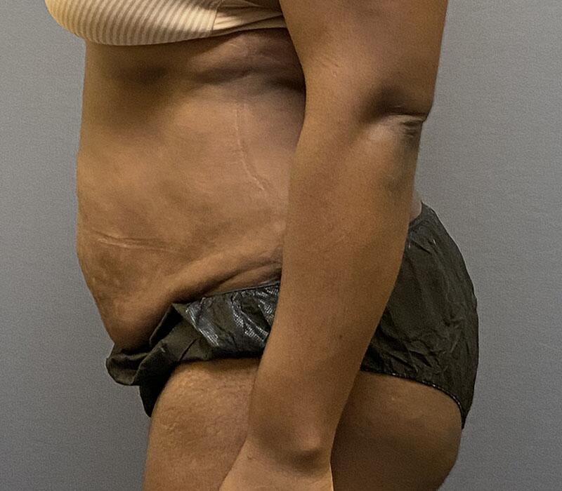 Tummy Tuck Before & After Image