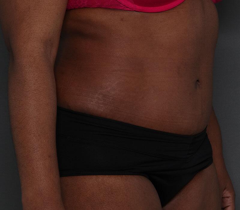 Tummy Tuck Before & After Image