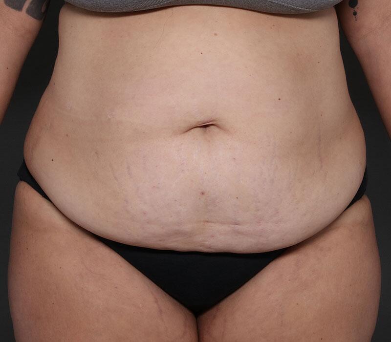 Tummy Tuck Before & After Image