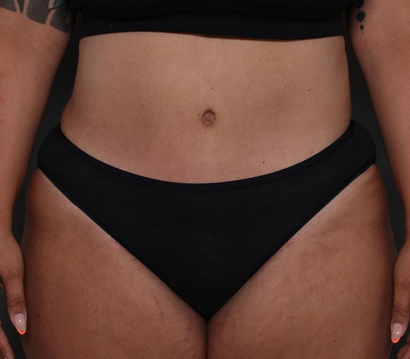 Tummy Tuck Before & After Image