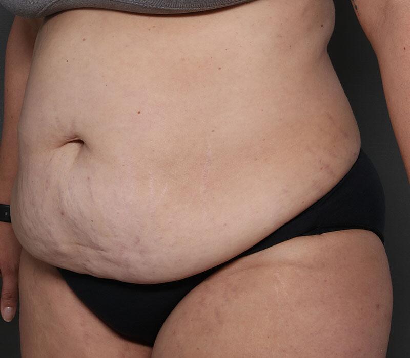 Tummy Tuck Before & After Image