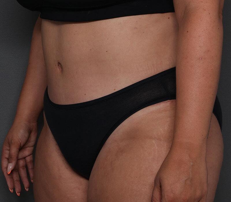 Tummy Tuck Before & After Image