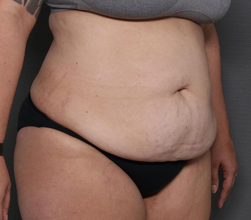 Tummy Tuck Before & After Image