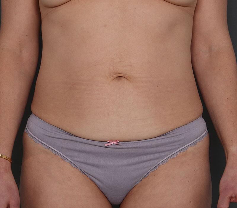 Tummy Tuck Before & After Image