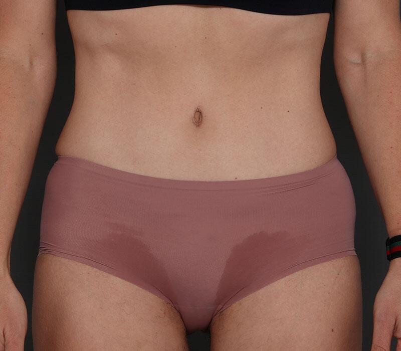 Tummy Tuck Before & After Image