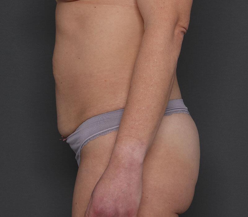 Tummy Tuck Before & After Image