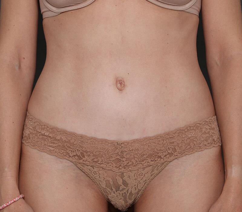 Tummy Tuck Before & After Image