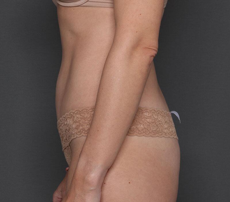 Tummy Tuck Before & After Image